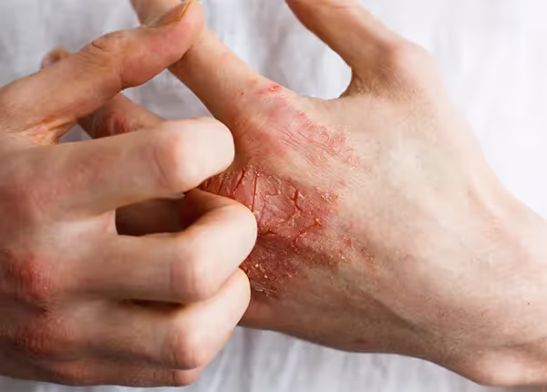 Close-up of eczema on the skin of a pair of hands